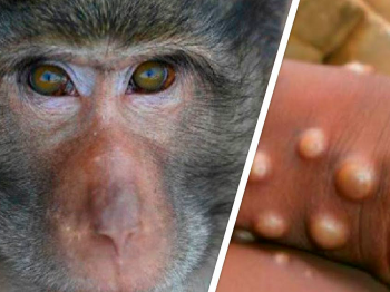 Первая смерть от оспы обезьян зафиксирована в Нигерии